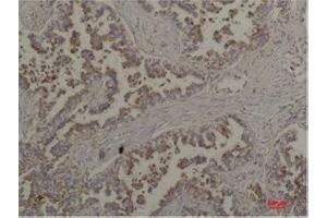 Immunohistochemistry (IHC) analysis of paraffin-embedded Human Lung Carcinoma using Flotillin-2 Rabbit Polyclonal Antibody diluted at 1:200. (Flotillin 2 Antikörper)