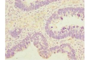 Immunohistochemistry of paraffin-embedded human ovarian cancer using ABIN7171132 at dilution of 1:100 (SYCE1 Antikörper  (AA 132-351))