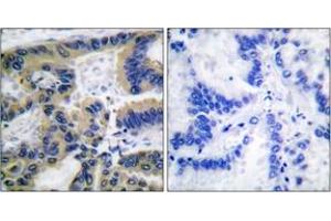 Immunohistochemistry analysis of paraffin-embedded human lung carcinoma tissue, using Caspase 7 (Cleaved-Asp198) Antibody. (Caspase 7 Antikörper  (Cleaved-Asp198))