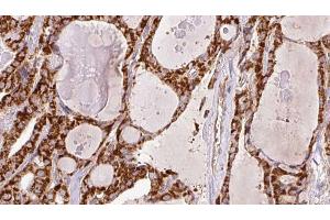 ABIN6266446 at 1/100 staining Human thyroid cancer tissue by IHC-P. (CD28 Antikörper  (C-Term))