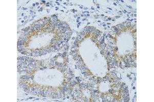 Immunohistochemistry of paraffin-embedded Human colon carcinoma using DNAJC19 Polyclonal Antibody at dilution of 1:100 (40x lens). (DNAJC19 Antikörper)