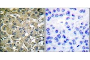 Immunohistochemistry analysis of paraffin-embedded human breast carcinoma tissue, using Keratin 18 (Ab-33) Antibody. (Cytokeratin 18 Antikörper  (AA 1-50))