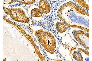 ABIN6257299 and ABIN6275373 at 1/100 staining Human ovarian cancer by IHC-P. (KCNK17 Antikörper  (C-Term))