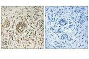 Immunohistochemistry analysis of paraffin-embedded human breast carcinoma tissue, using CIB2 antibody. (CIB2 Antikörper)