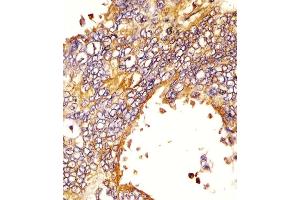 (ABIN387816 and ABIN2843905) staining EGFR in human lung adenocarcinoma sections by Immunohistochemistry (IHC-P - paraformaldehyde-fixed, paraffin-embedded sections). (EGFR Antikörper)