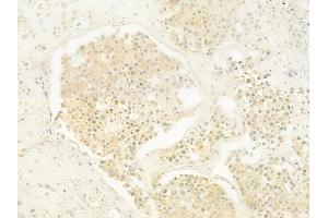ABIN6262334 and ABIN6279483 at 1/100 staining human prostate carcinoma by IHC-P.