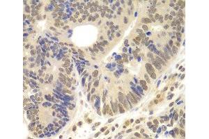 Immunohistochemistry of paraffin-embedded Human colon carcinoma using LHX4 Polyclonal Antibody at dilution of 1:100 (40x lens). (LHX4 Antikörper)