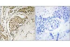 Immunohistochemistry analysis of paraffin-embedded human breast carcinoma tissue, using NOM1 Antibody. (NOM1 Antikörper  (AA 661-710))