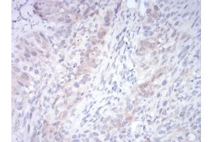 Immunohistochemical analysis of paraffin-embedded cervical cancer tissues using RND3 mouse mAb with DAB staining. (RND3 Antikörper  (AA 104-241))