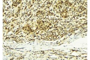 ABIN6279208 at 1/100 staining Human breast cancer tissue by IHC-P. (CABIN1 Antikörper  (Internal Region))