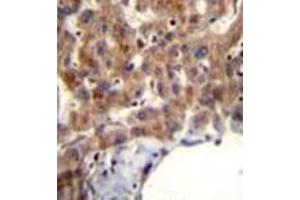 Immunohistochemistry analysis in formalin fixed and paraffin embedded human liver tissue reacted with MBNL2 Antibody (C-term) followed which was peroxidase conjugated to the secondary antibody and followed by AB staining.