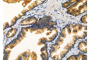 ABIN6263112 and ABIN6266890 at 1/100 staining Human prostate cancer by IHC-P. (MLK4 Antikörper  (C-Term))