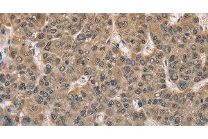 Immunohistochemistry of paraffin-embedded Human liver cancer tissue using DACH2 Polyclonal Antibody at dilution 1:40