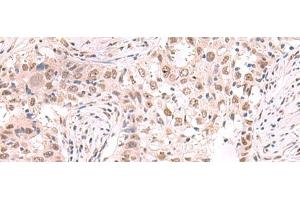 Immunohistochemistry of paraffin-embedded Human esophagus cancer tissue using ZNF559 Polyclonal Antibody at dilution of 1:80(x200) (ZNF559 Antikörper)