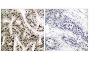 Immunohistochemical analysis of paraffin- embedded human breast carcinoma tissue using NF-κB p105/p50 (phospho-Ser337) antibody (E011017). (NFKB1 Antikörper  (pSer337))