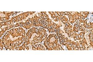 Immunohistochemistry of paraffin-embedded Human thyroid cancer tissue using NPC2 Polyclonal Antibody at dilution of 1:80(x200)