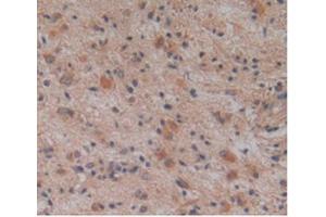 IHC-P analysis of Human Glioma Tissue, with DAB staining. (ALT Antikörper  (AA 255-496))