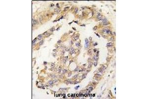 Formalin-fixed and paraffin-embedded human lung carcinoma tissue reacted with Olfm1 Antibody (N-term) (ABIN389177 and ABIN2839340) , which was peroxidase-conjugated to the secondary antibody, followed by DAB staining. (Olfactomedin 1 Antikörper  (N-Term))