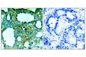 Immunohistochemical analysis of paraffin-embedded human breast carcinoma tissue using PAK1(Phospho-Thr212) Antibody(left) or the same antibody preincubated with blocking peptide(right). (PAK1 Antikörper  (pThr212))