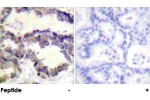 Immunohistochemical analysis of paraffin-embedded human lung carcinoma tissue using CASP2 polyclonal antibody . (Caspase 2 Antikörper  (Ser140))