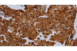 Immunohistochemistry of paraffin-embedded Human prostate cancer tissue using ENTPD7 Polyclonal Antibody at dilution 1:60 (ENTPD7 Antikörper)