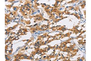 The image is immunohistochemistry of paraffin-embedded Human thyroid cancer tissue using ABIN7130969(SAR1B Antibody) at dilution 1/20. (SAR1B Antikörper)