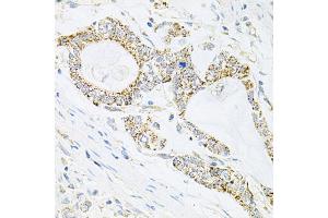 Immunohistochemistry of paraffin-embedded human gastric cancer using IRS1 antibody (ABIN5970075) at dilution of 1/100 (40x lens). (IRS1 Antikörper)
