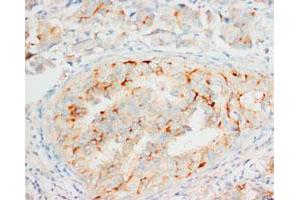 Immunohistochemical staining of OPCML on formalin fixed, paraffin embedded human mammary cancer with OPCML polyclonal antibody . (OPCML Antikörper  (C-Term))