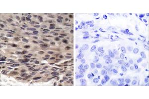 P-Peptide - +Immunohistochemical analysis of paraffin-embedded human breast carcinoma tissue using FKHRL1 (phospho-Ser253) antibody. (eIF4EBP1 Antikörper  (pThr36))