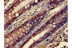 Immunohistochemistry of paraffin-embedded human colon cancer using ABIN7172843 at dilution of 1:100 (RHOA Antikörper  (AA 1-191))