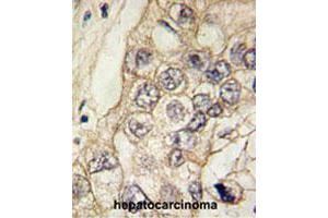 Formalin-fixed and paraffin-embedded human hepatocellular carcinoma tissue reacted with CDH6 polyclonal antibody , which was peroxidase-conjugated to the secondary antibody, followed by DAB staining. (CDH6 Antikörper  (C-Term))