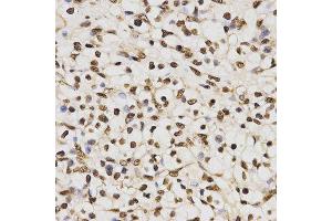 Immunohistochemistry of paraffin-embedded human kidney cancer tissue using H3R17me2a antibody at dilution of 1:200 (x400 lens) (Histone 3 Antikörper  (H3R17me2a))