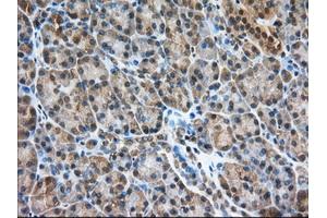 Immunohistochemical staining of paraffin-embedded Adenocarcinoma of Human colon tissue using anti-PDE4A mouse monoclonal antibody. (PDE4A Antikörper)