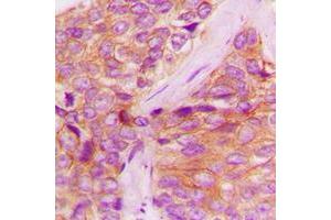 Immunohistochemical analysis of JAK1 (pY1022) staining in human breast cancer formalin fixed paraffin embedded tissue section. (JAK1 Antikörper  (C-Term, pTyr1022))