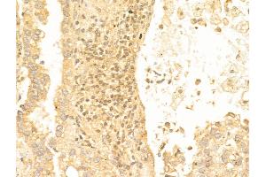 ABIN6259708 and ABIN6267079 at 1/100 staining Human lung cancer by IHC-P. (FOXO1 Antikörper  (acLys294))