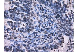 Immunohistochemical staining of paraffin-embedded Adenocarcinoma of colon tissue using anti-RPA2 mouse monoclonal antibody. (RPA2 Antikörper)