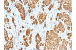 Immunohistochemical staining (Formalin-fixed paraffin-embedded sections) of human melanoma with S100B recombinant monoclonal antibody, clone S100B/1706R .