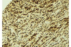 ABIN6269360 at 1/100 staining Human breast cancer tissue by IHC-P. (STAT4 Antikörper  (C-Term))