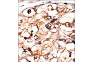 Formalin-fixed and paraffin-embedded human cancer tissue reacted with the primary antibody, which was peroxidase-conjugated to the secondary antibody, followed by AEC staining. (PGK2 Antikörper  (N-Term))