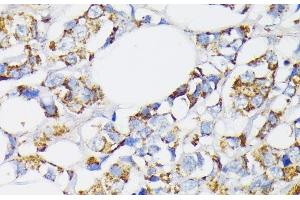 Immunohistochemistry of paraffin-embedded Human breast cancer using USP33 Polyclonal Antibody at dilution of 1:100 (40x lens). (USP33 Antikörper)