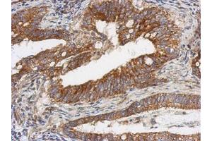 IHC-P Image Immunohistochemical analysis of paraffin-embedded human gastric cancer, using TSFM, antibody at 1:500 dilution. (TSFM Antikörper)