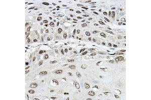 Immunohistochemistry of paraffin-embedded human esophageal cancer using TRRAP Rabbit pAb (ABIN7270906) at dilution of 1:100 (40x lens). (TRRAP Antikörper)