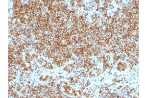Formalin-fixed, paraffin-embedded human Lymphoma stained with CD45 Monoclonal Antibody (SPM569+SPM570). (CD45 Antikörper)