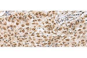 Immunohistochemistry of paraffin-embedded Human esophagus cancer tissue using PRPF40A Polyclonal Antibody at dilution of 1:60(x200) (PRPF40A Antikörper)
