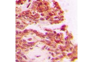 Immunohistochemical analysis of Carboxypeptidase A1 staining in human breast cancer formalin fixed paraffin embedded tissue section. (CPA1 Antikörper  (Center))