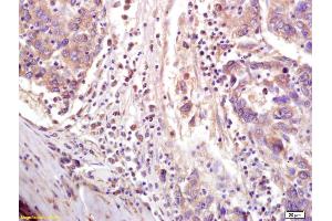 Formalin-fixed and paraffin embedded human lung carcinoma labeled with Anti-CTCF Polyclonal Antibody, Unconjugated (ABIN703976) at 1:200 followed by conjugation to the secondary antibody and DAB staining. (CTCF Antikörper  (AA 451-550))