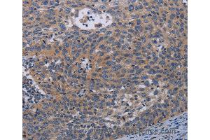 Immunohistochemistry of Human cervical cancer using PAPPA Polyclonal Antibody at dilution of 1:50 (PAPPA Antikörper)