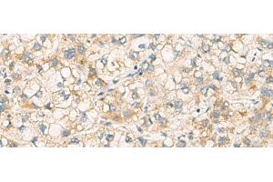Immunohistochemistry of paraffin-embedded Human liver cancer tissue using PAFAH1B3 Polyclonal Antibody at dilution of 1:70(x200)
