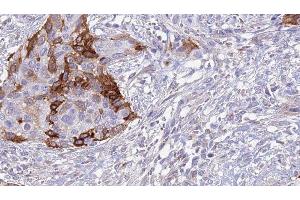 ABIN6277025 at 1/100 staining Human urothelial cancer tissue by IHC-P. (CD99 Antikörper  (Internal Region))