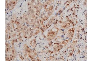 ABIN6265317 and ABIN6269240 at 1/200 staining human breast cancer tissue sections by IHC-P.